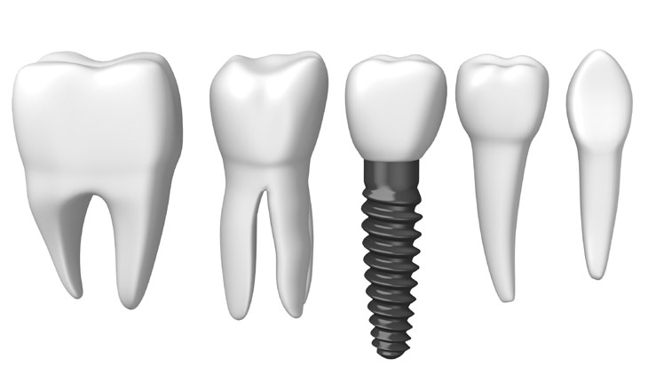 Implantate von Zahnarzt 1100 Wien